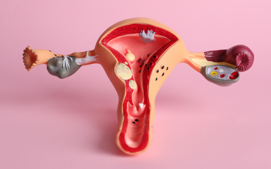What is endometriosis? A model of a uterus demonstrates endometriosis.