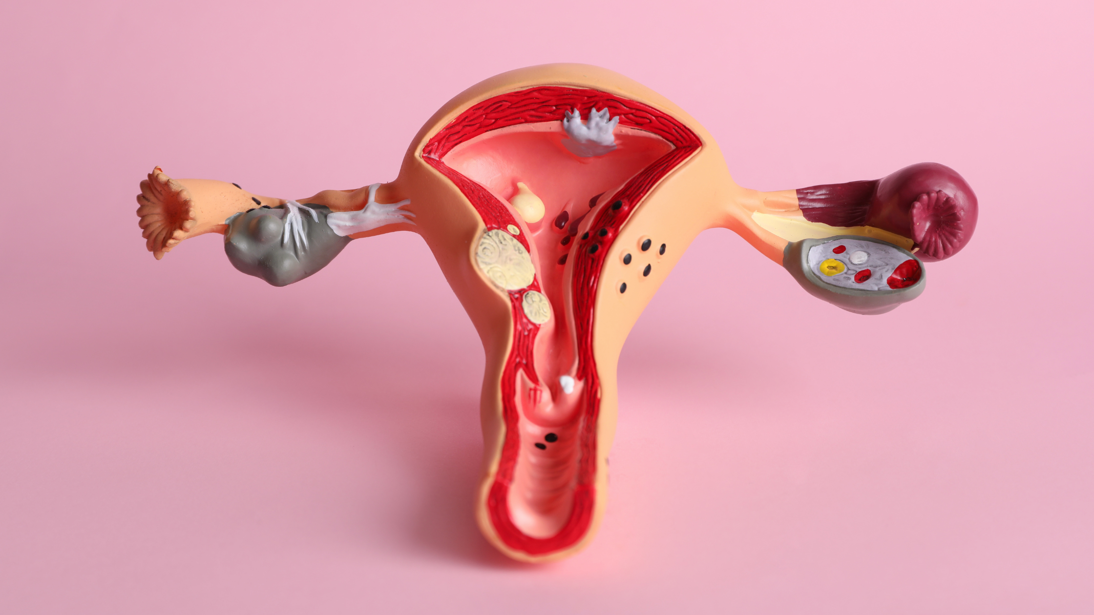 What is endometriosis? A model of a uterus demonstrates endometriosis.