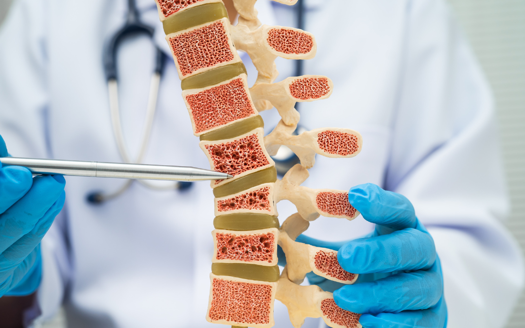 Osteoporosis Prevention After 50